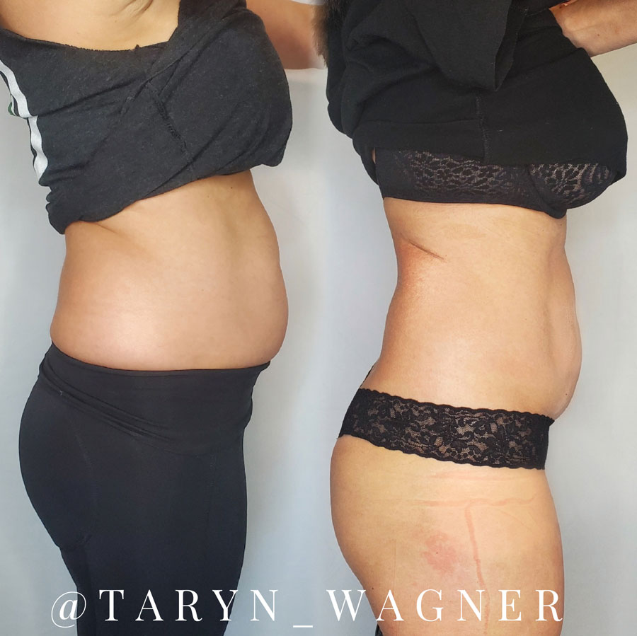 Top 5 Body Parts for Cryoskin Slimming & Toning — Taryn Wagner