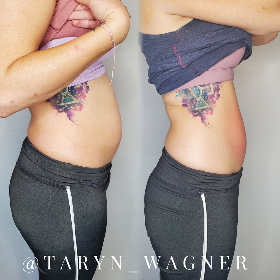 Cryoskin Body Treatment by Taryn Wagner in Lodi, CA