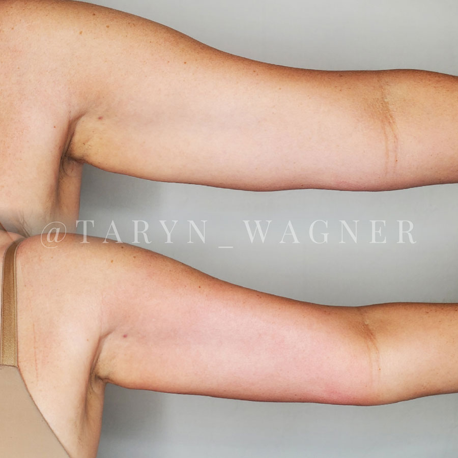 Cryoskin Body Treatment by Taryn Wagner in Lodi, CA