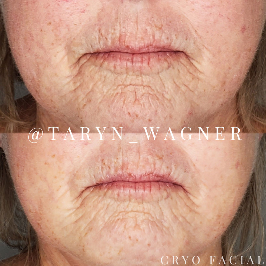 Cryo Facial by Taryn Wagner in Lodi, CA